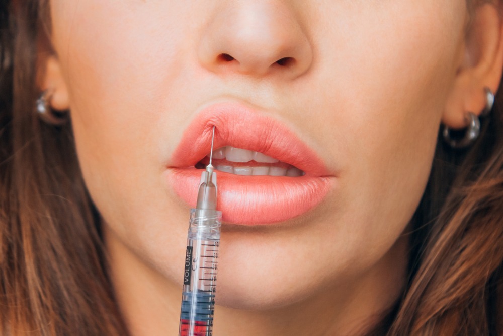 Injection Acide Hyaluronique lèvre